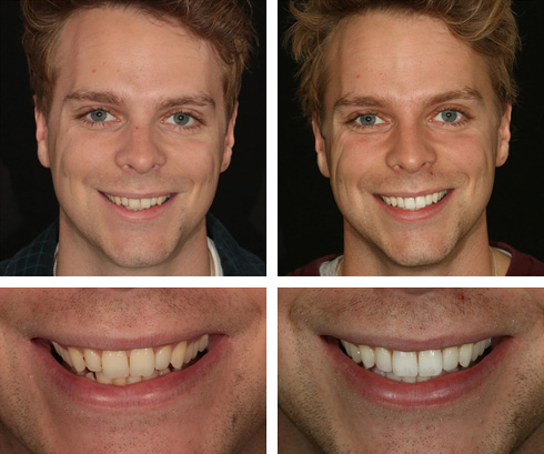 Before After